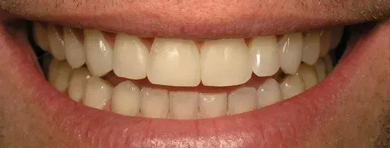 A close up of a man 's mouth with white teeth. A close up of a man 's mouth with white teeth.