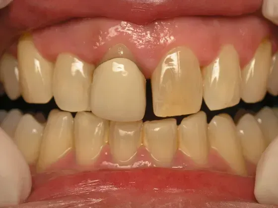 A close up of a person 's teeth with a missing tooth. A close up of a person 's teeth with a missing tooth.