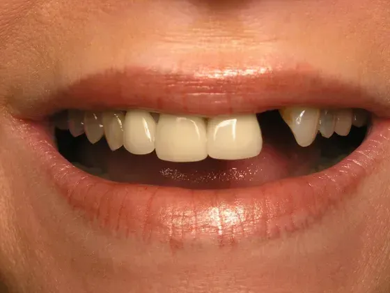 A close up of a woman 's mouth with missing teeth. A close up of a woman 's mouth with missing teeth.