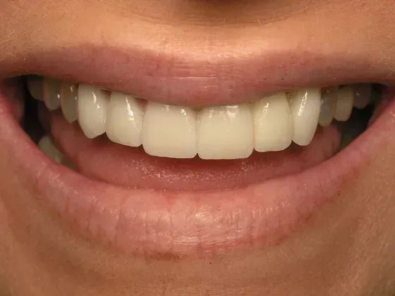 A close up of a person 's smile with white teeth. A close up of a person 's smile with white teeth.