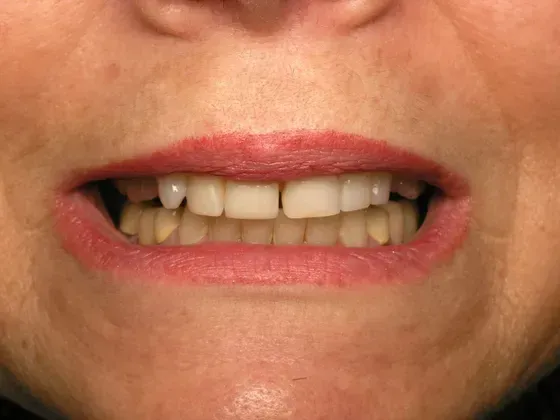 A close up of a woman 's mouth with missing teeth. A close up of a woman 's mouth with missing teeth.