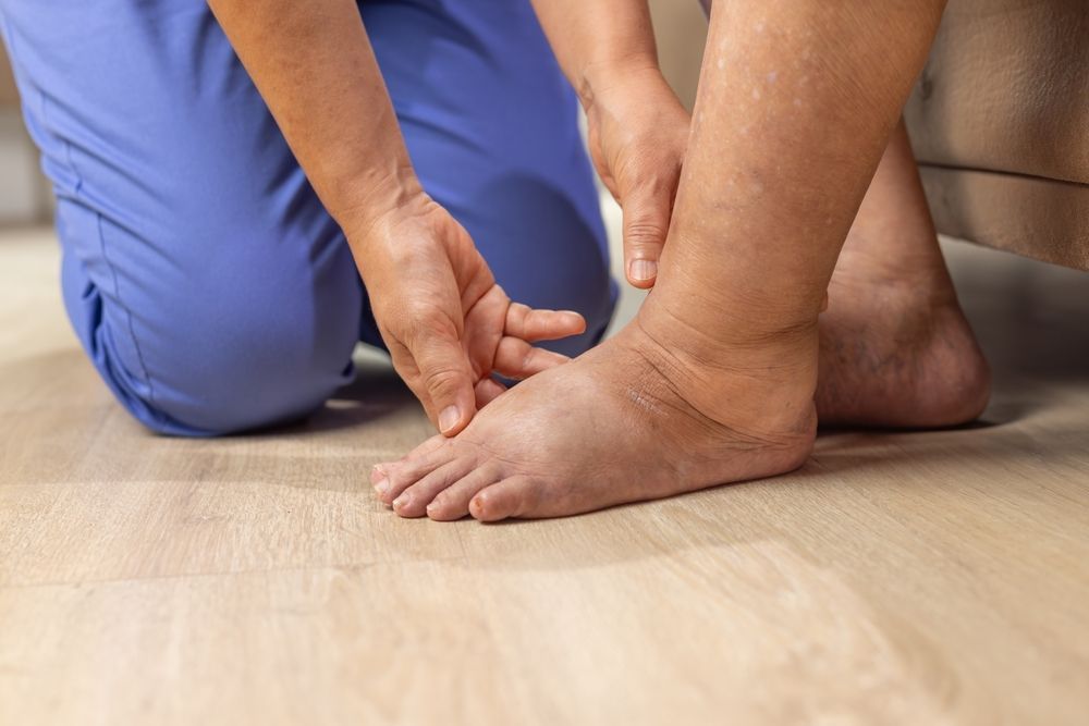 Swollen ankles and feet being examined by a person in blue scrubs.