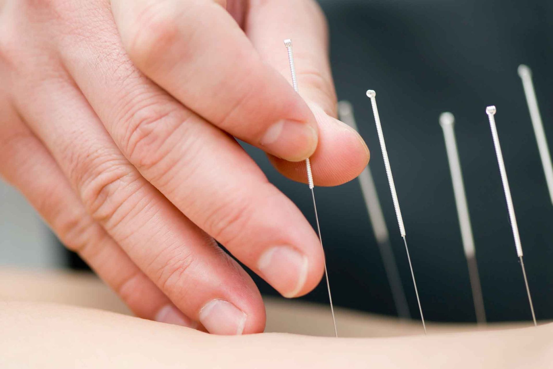 A Person Is Getting Acupuncture On Their Back – Dunbar, WV - Smith & Jones Chiropractic