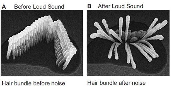 Hearing Loss