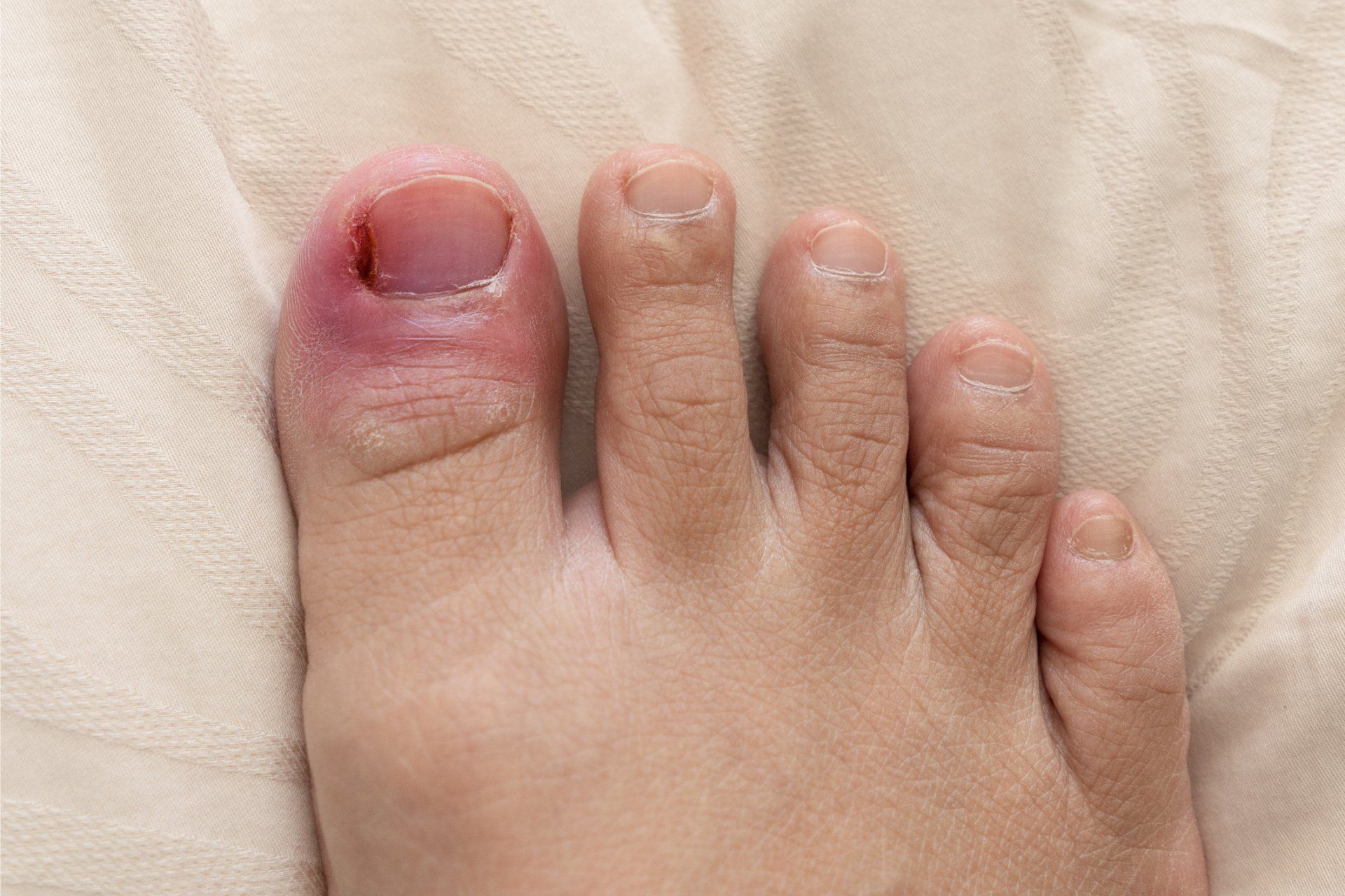 Ingrown Toenails — Brisbane, Qld — McLean & Partners Podiatrists