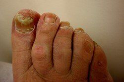 Fungal on Toenails — Brisbane, Qld — McLean & Partners Podiatrists