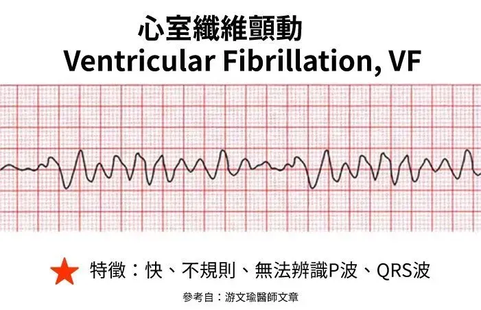 致命性心律不整:心室纖維顫動 (VF) 波形圖解 - AED 電擊去顫原理