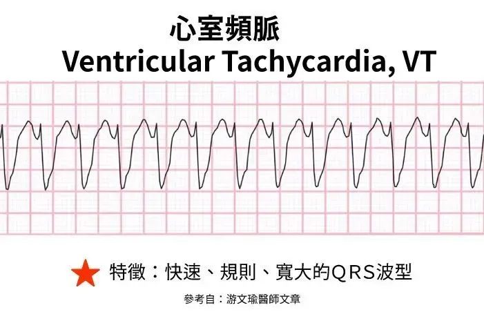 致命性心律不整:心室頻脈 (VT) 波形圖解 - AED 自動分析範例