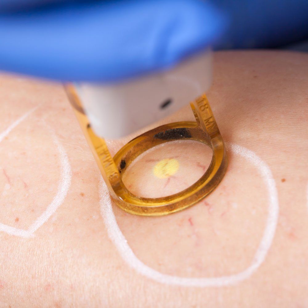 Spider Vein Treatment — Irving, TX — Dr. Reddy Medspa