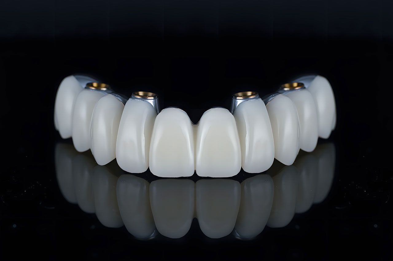 All-On-4 Dental Implants In Tampa, What To Know About Full-Arch Tooth Replacement