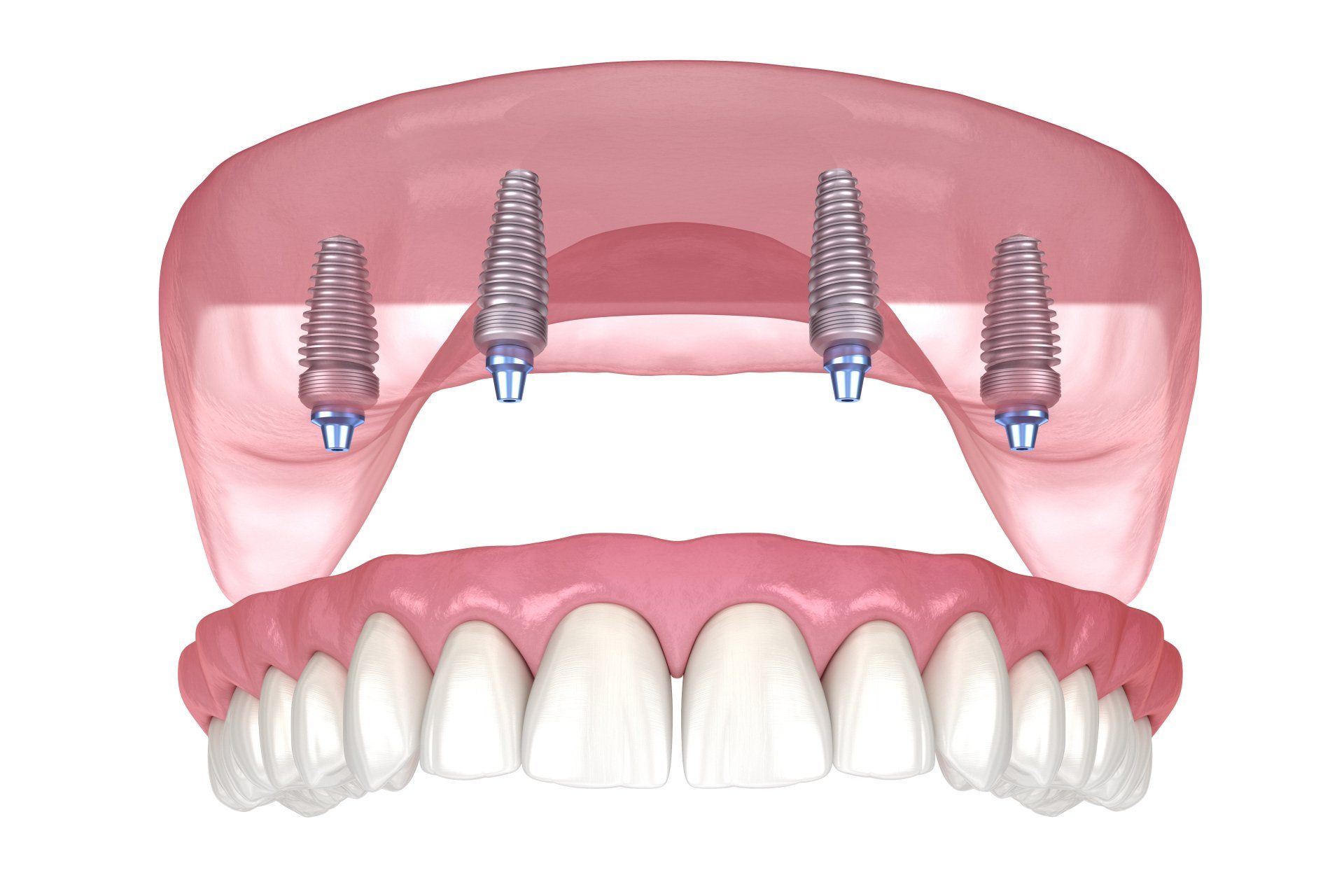All-on-4 dental implant supported denture.