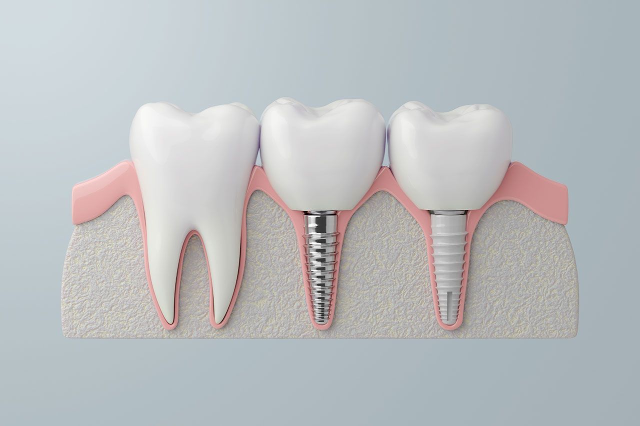 Dental Implant Costs In Tampa, Understanding What You Are Really Paying For