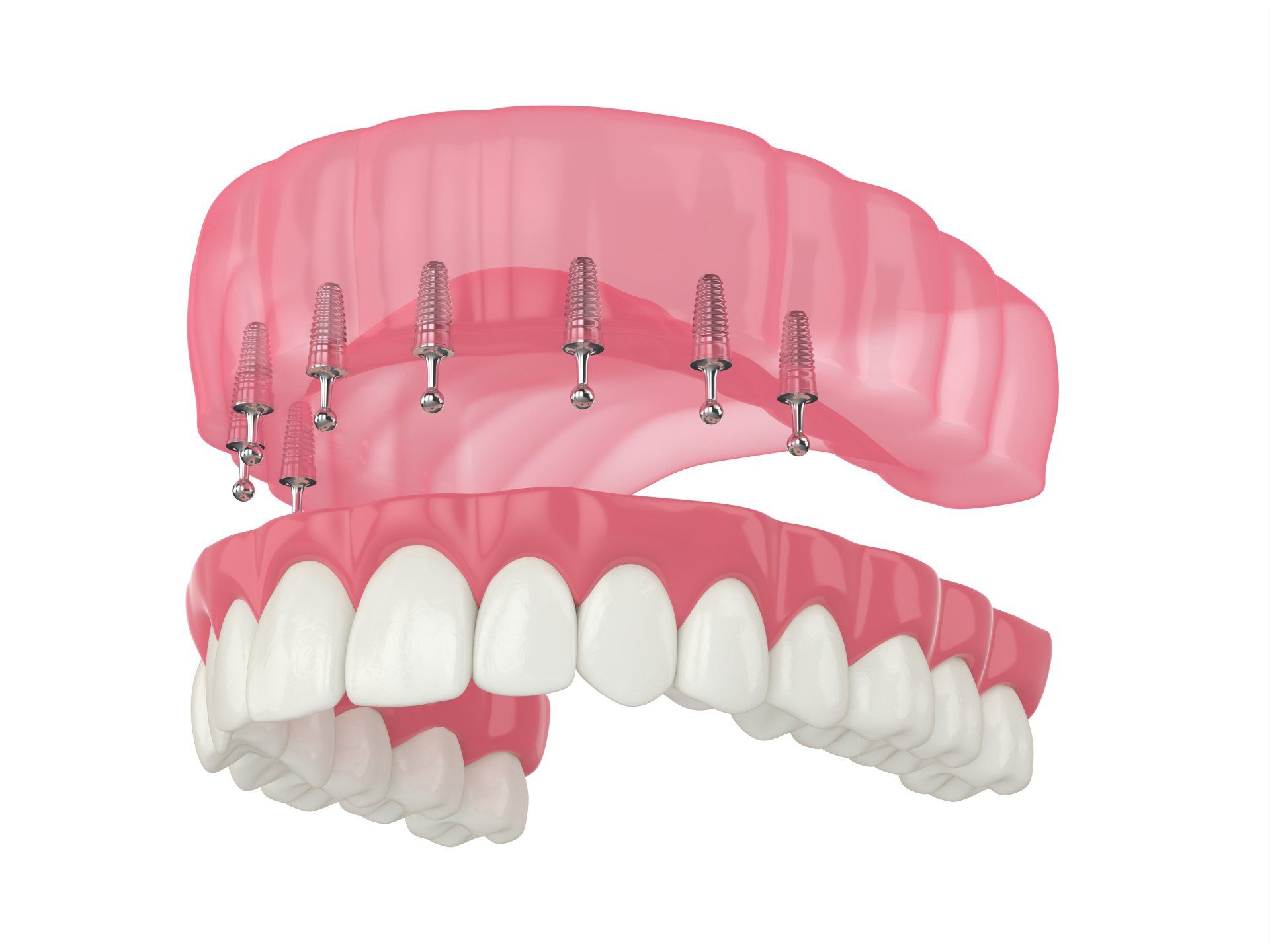 All-on-6 dental implants All-on-6 dental implants