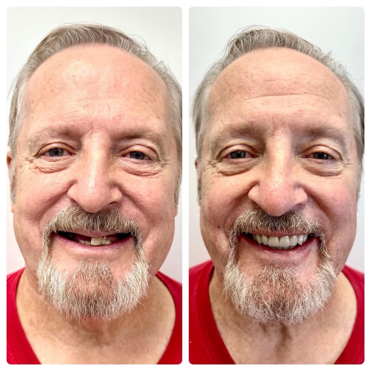 Fixed All On 4 implants before and after image