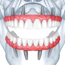 An illustration of a person's teeth with dental implants.