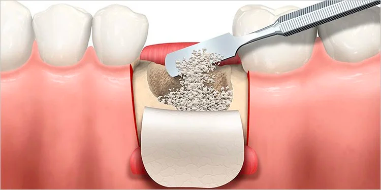 Bone graft Bone graft image