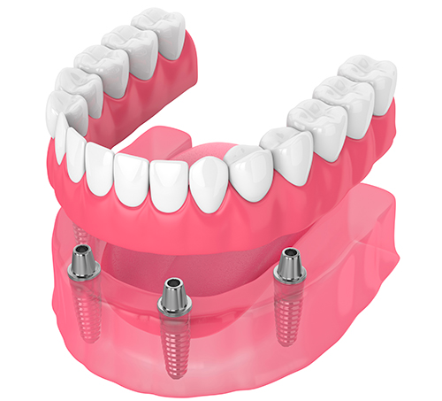 A model of a full denture with four dental implants.