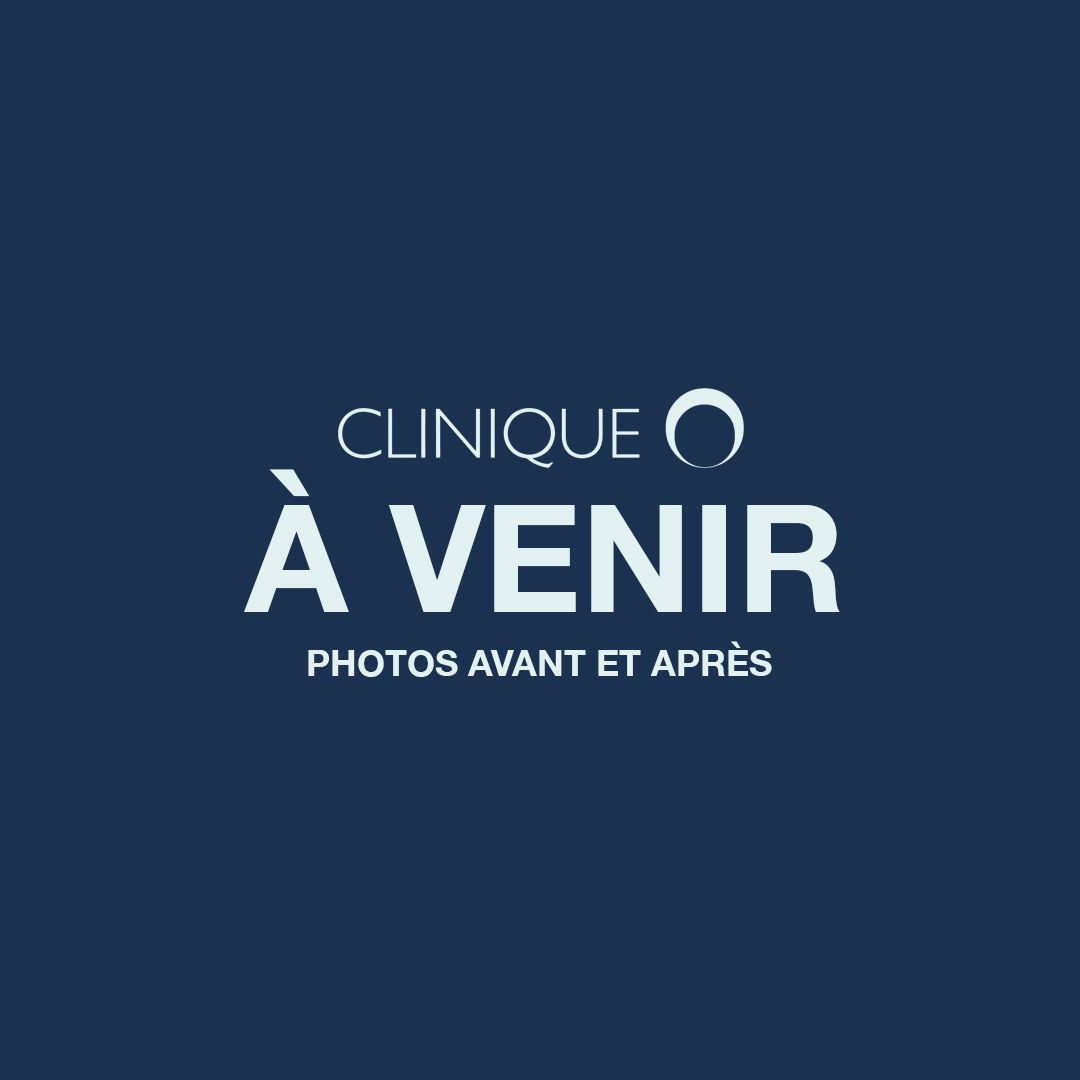 Traitement des Grains de Beauté au Laser Clinique O Chirurgie plastique et Esthétique