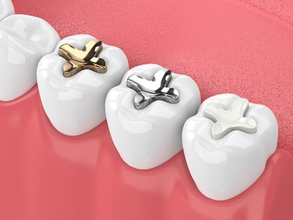 Dental Fillings — Lemont, IL — John Mastrud DDS Dental Fillings — Lemont, IL — John Mastrud DDS