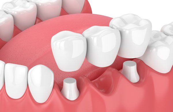 Dental Bridges — Lemont, IL — John Mastrud DDS Dental Bridges — Lemont, IL — John Mastrud DDS