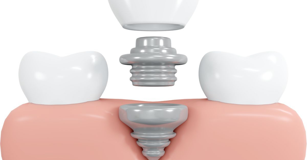 Same Day Dental Crowns in San Diego Marina District Dentistry