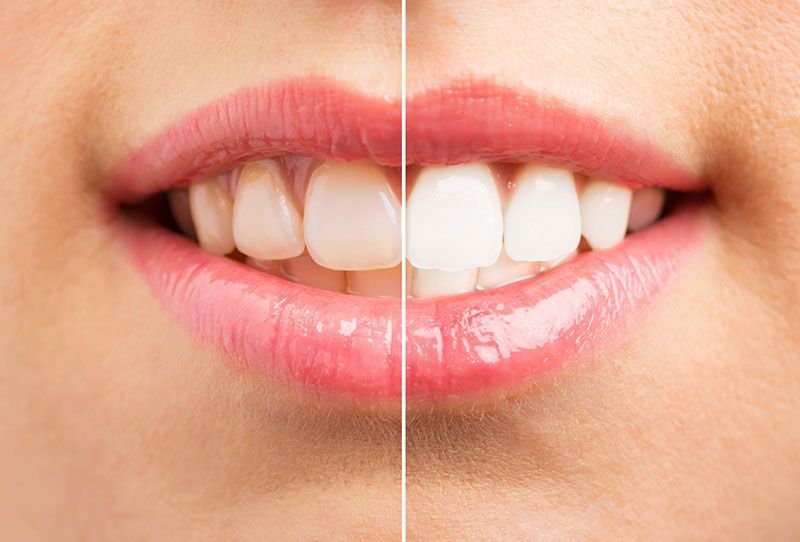 DENTAL PLUS SLP - Blanqueamientos dentales