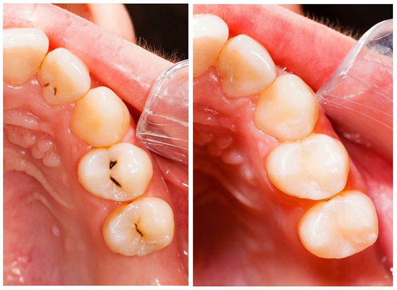 DENTAL PLUS SLP - Resinas