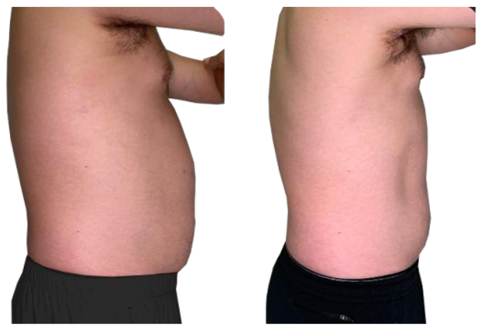 Side-by-side profile views of a bare torso showing abdominal protrusion and a flatter stomach after weight loss.