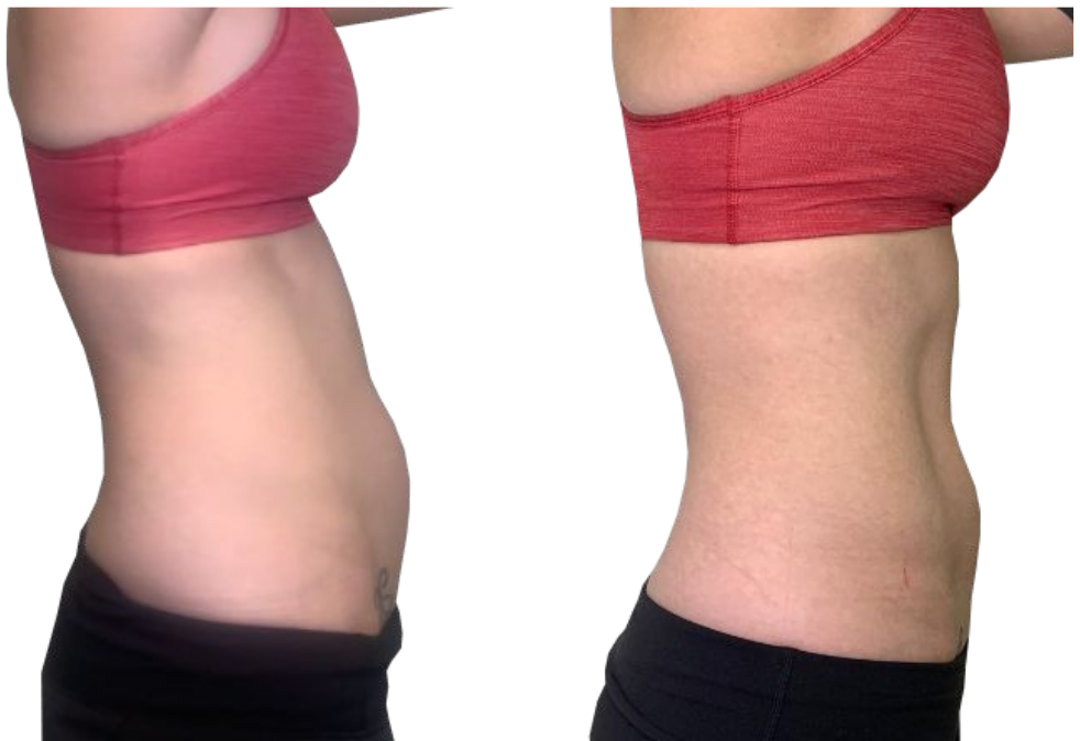 Side-by-side torso profile comparison showing a flatter stomach after weight loss, both in pink sports bras.