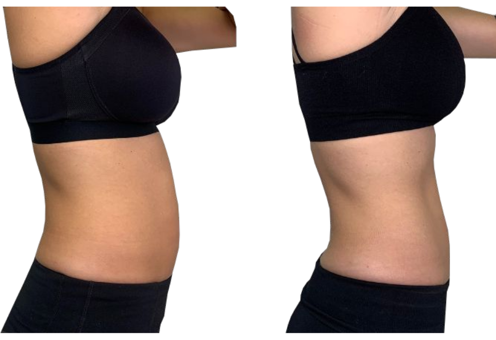 Side-by-side torso photos showing a flatter abdomen after weight loss or body transformation