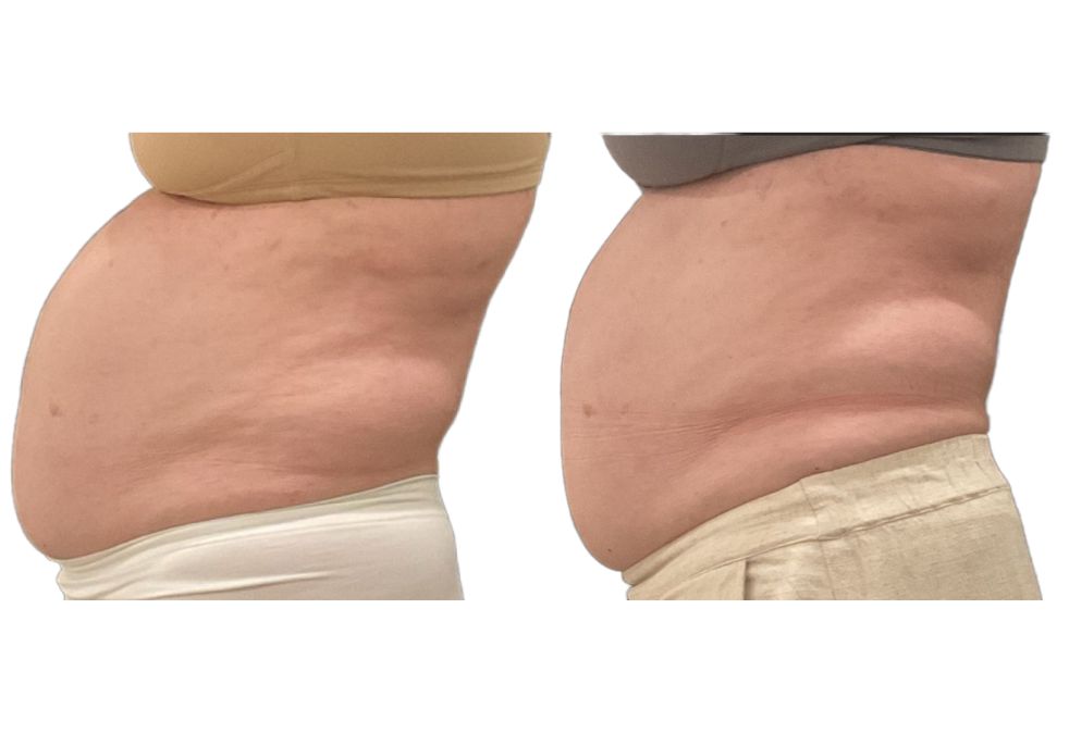 Side-by-side close-up of a stomach before and after weight loss, showing flatter abdominal profile on the right