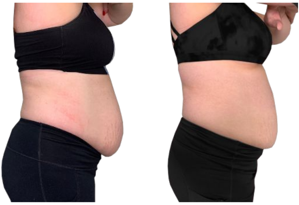Side-by-side comparison of a torso in black clothing, showing a larger belly on the left and a flatter stomach on the right