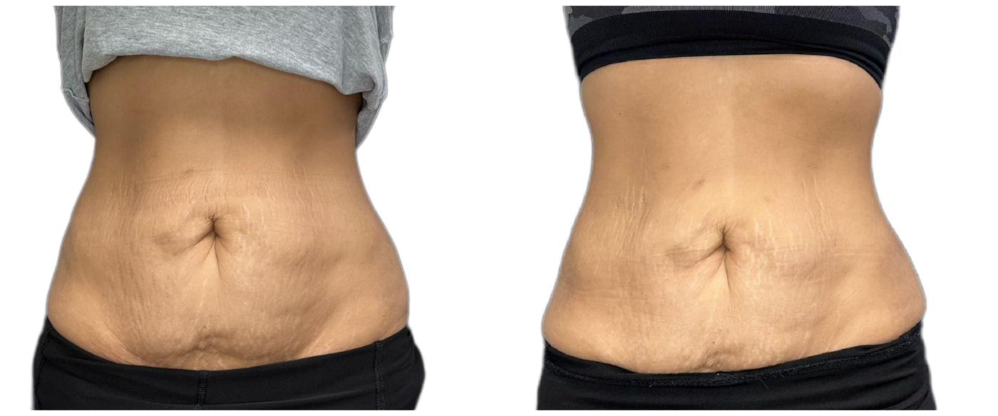 Side-by-side torso photos showing a flatter abdomen after a waistline change