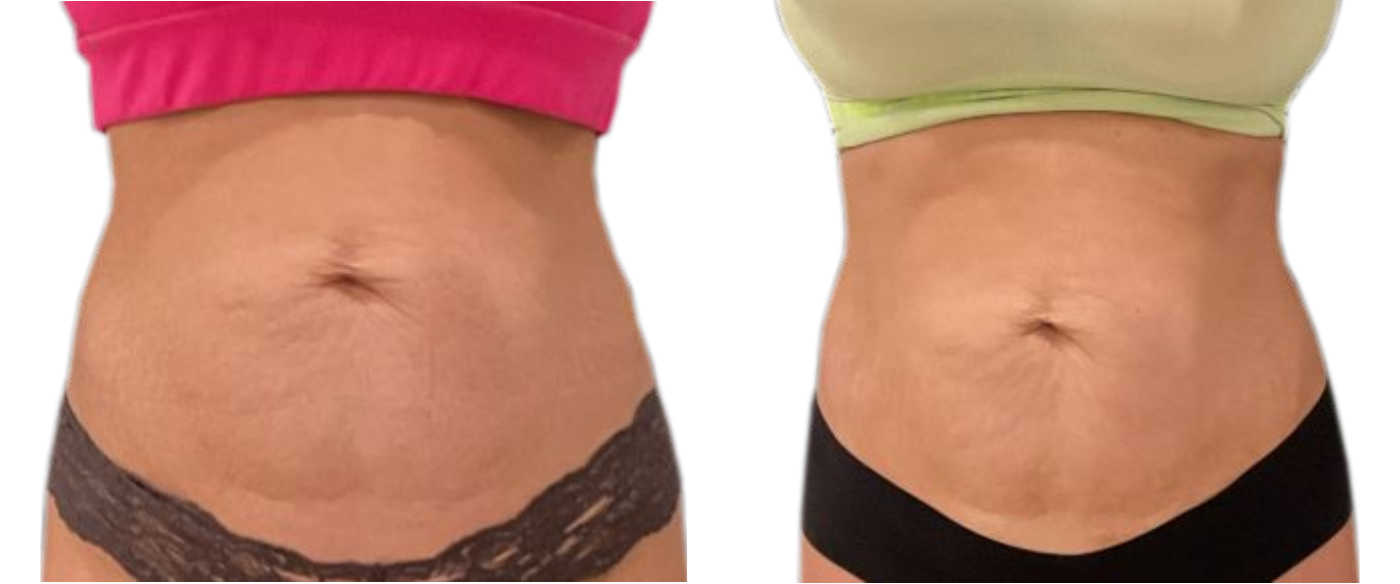 Side-by-side close-ups of a torso before and after weight loss, showing a flatter stomach.