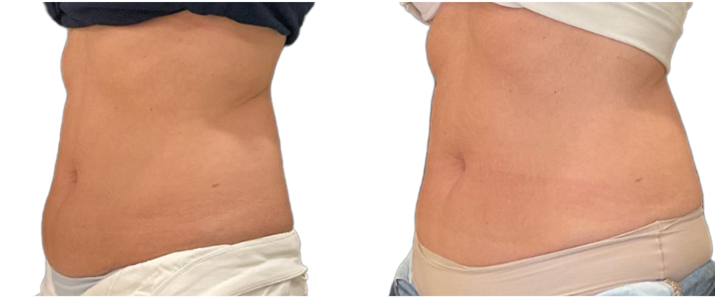 Side-by-side close-up of abdomen before and after: flatter, slimmer waistline on the right.