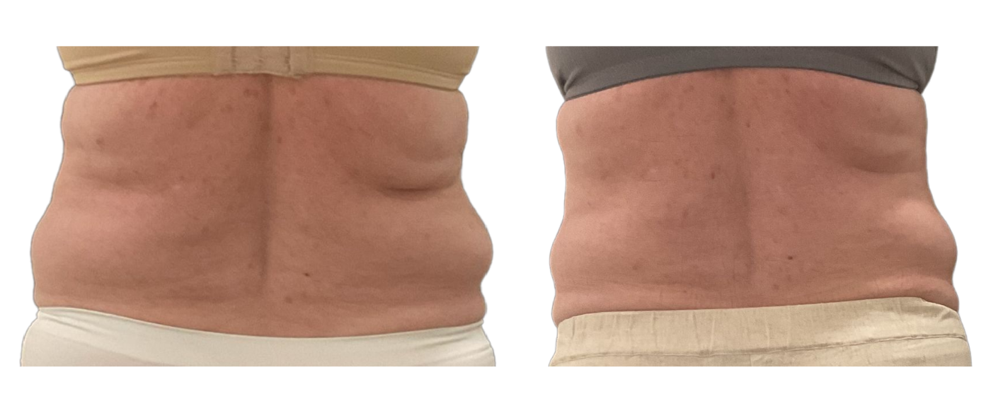 Side-by-side close-up of a torso before and after, showing a flatter abdomen on the right