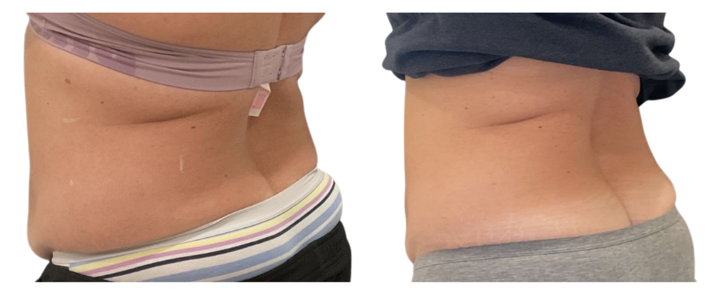 Side-by-side waist profile photos showing a flatter abdomen after treatment or weight loss.