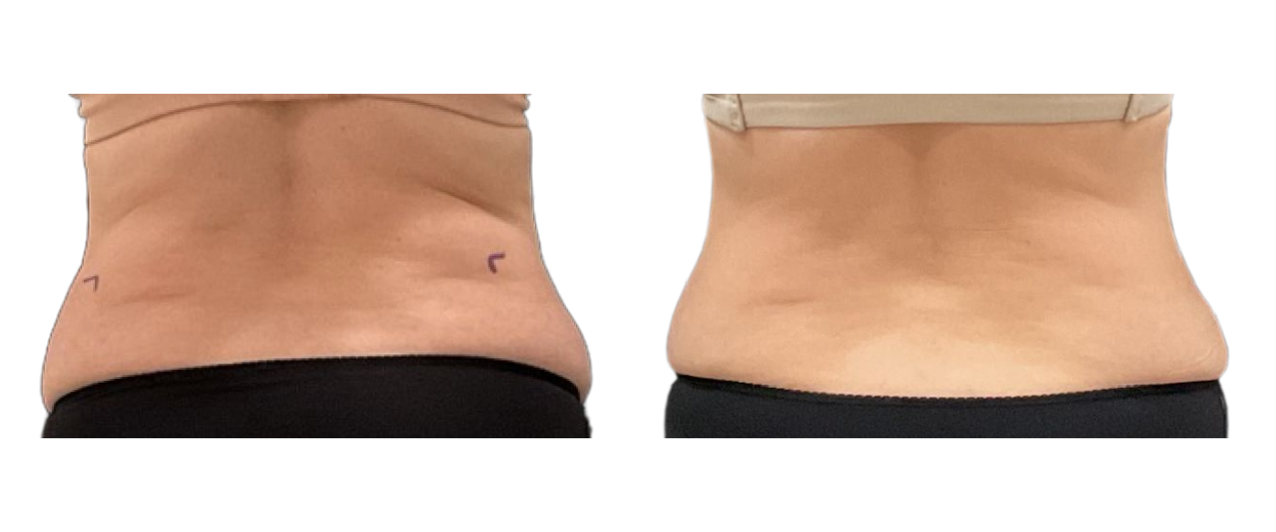 Side-by-side close-up of a torso showing before-and-after waist contour, with smoother skin on the right