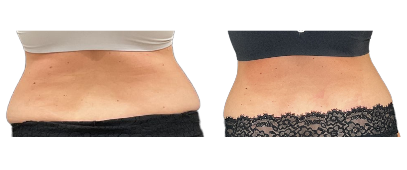 Side-by-side before-and-after view of a waist, showing smoother skin and tighter abdominal contour.