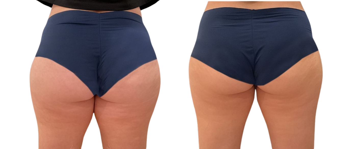 Back view of a person wearing navy high-waisted shapewear briefs, shown in before-and-after comparison.