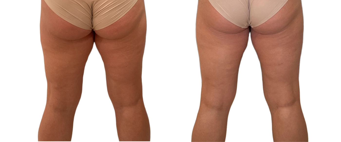 Two side-by-side photos of a person’s lower body in beige underwear, front and back views