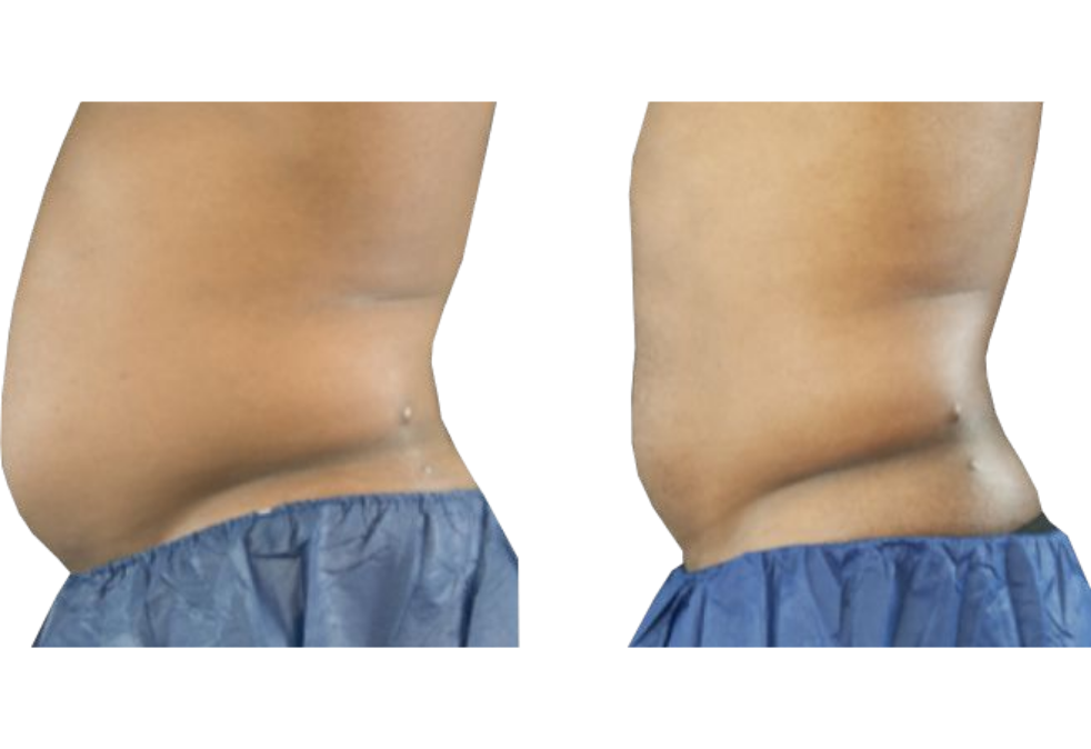 Side-by-side close-up of a waist in blue shorts, showing a flatter profile on the right