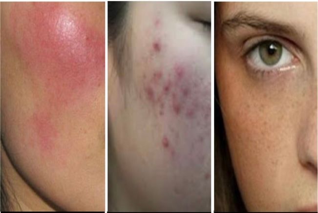 Three close-up facial skin views showing progressive stages of acne, from redness to healing.