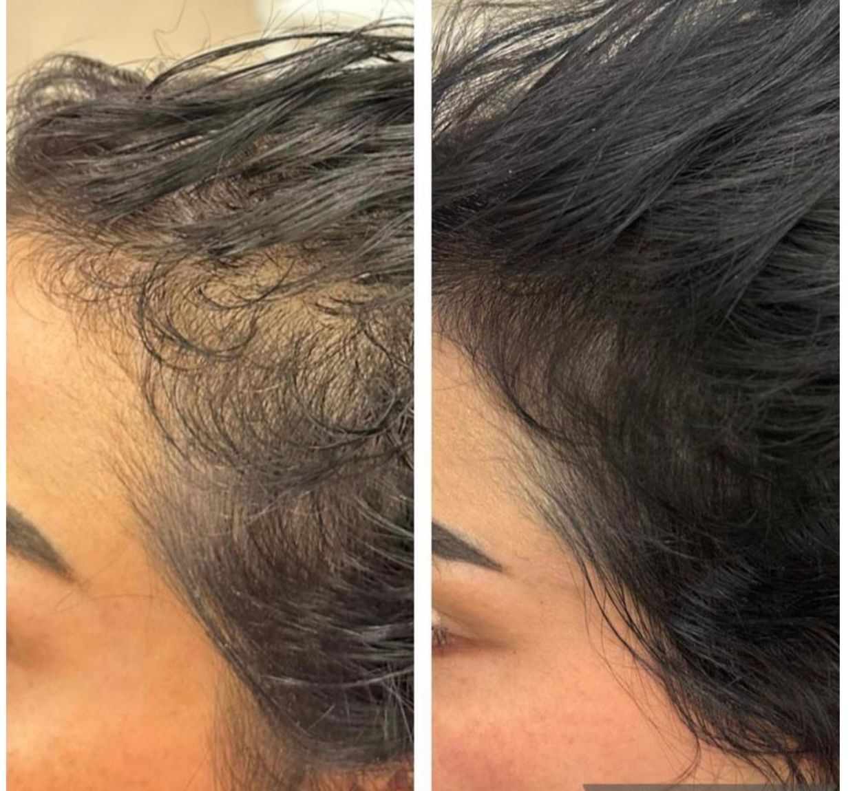 Hair loss before and after treatment, side view. Thinning hair on the left, fuller on the right.