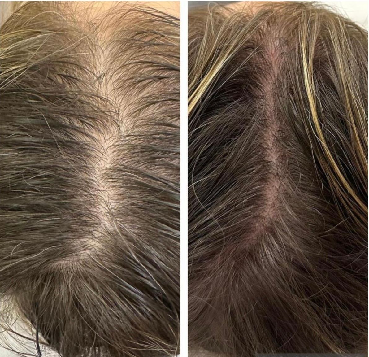 Two views of a person's scalp: before and after hair growth treatment, with noticeably thicker hair in the after image.