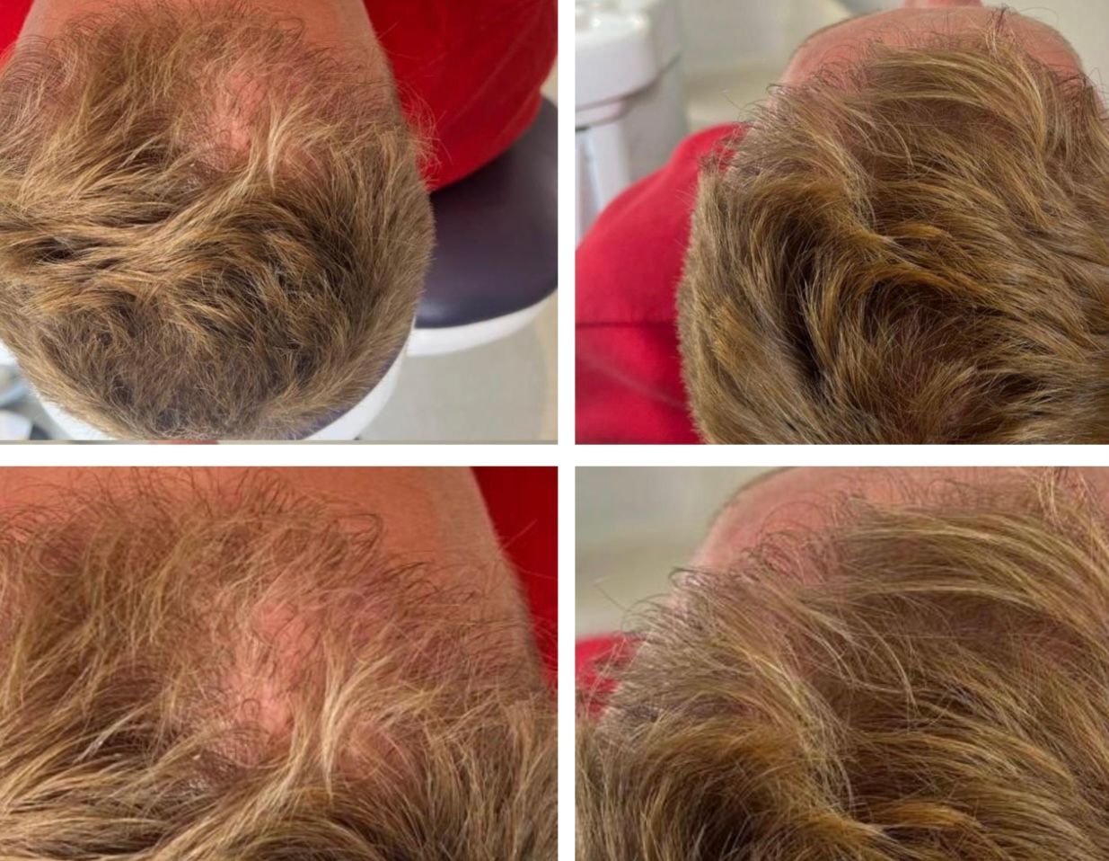 Four views of a person's scalp with thinning, light brown hair.