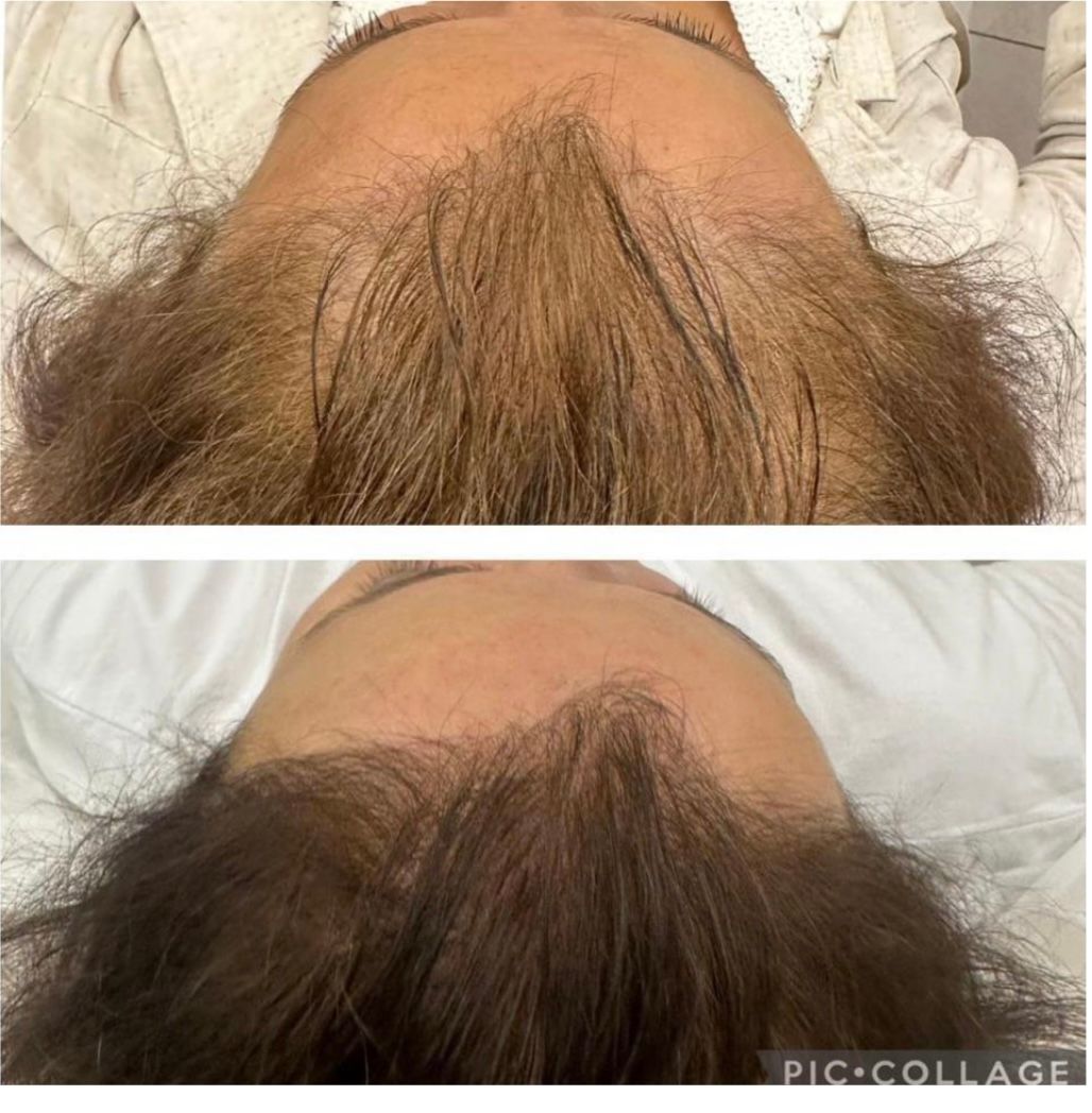 Top: thinning brown hair. Bottom: fuller, darker brown hair. Hair growth result.