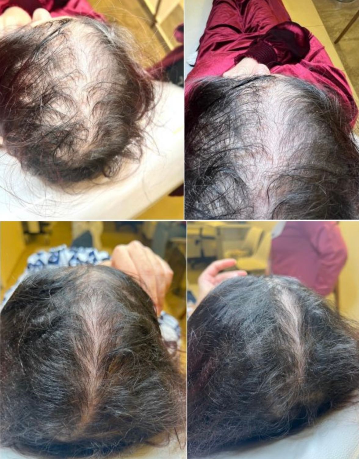 Four views of a person's scalp showing thinning hair, likely before/after treatment comparison.