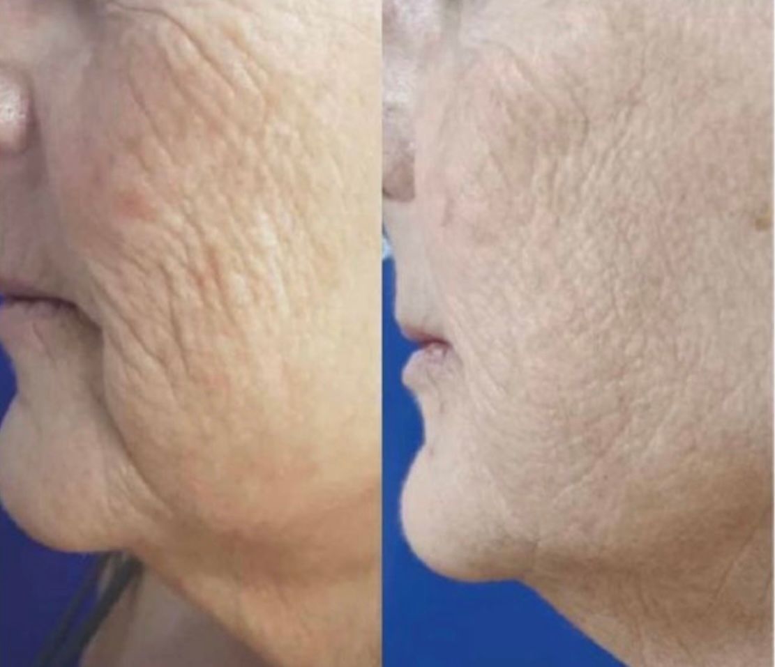 Side-by-side view of a face before and after skin tightening, showing a reduction in wrinkles.