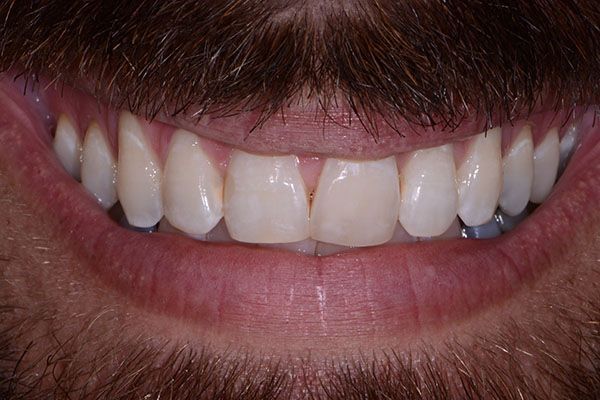A close up of a man 's teeth with a beard. Composite Bonding